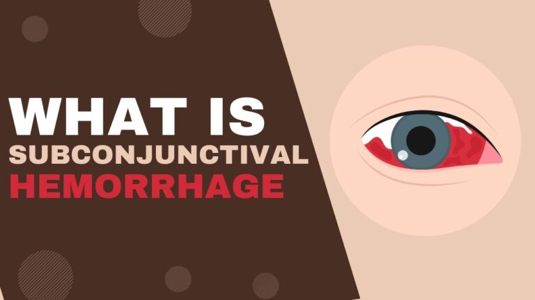 What is a Subconjunctival Hemorrhage - 918EyeDoctor